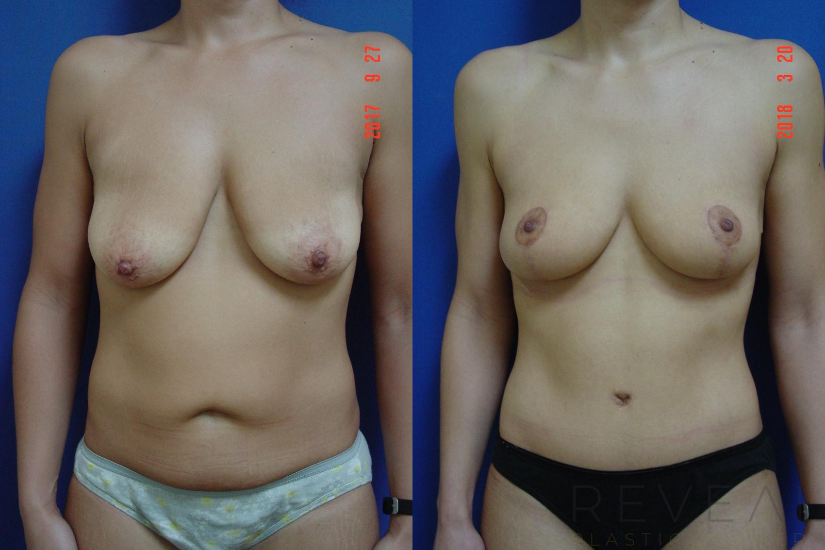 Before & After Breast Lift Case 248 View #1 View in San Jose, CA