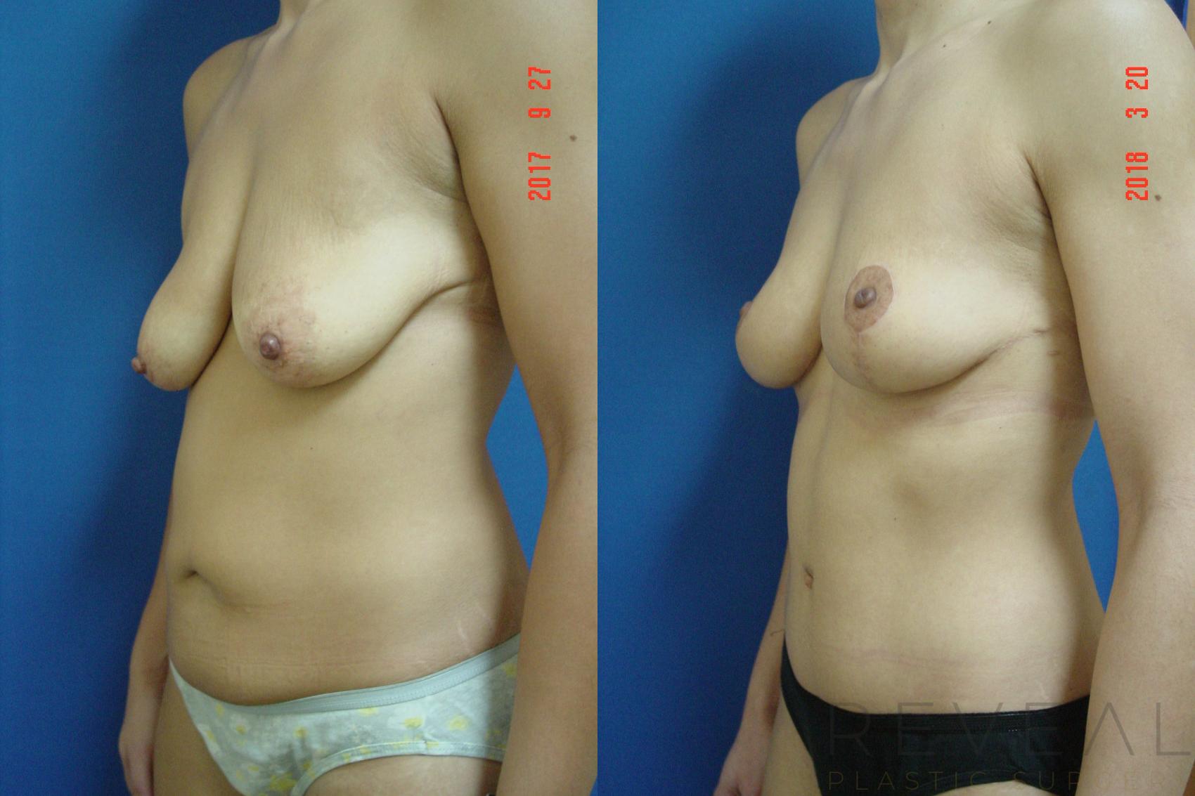 Before & After Breast Lift Case 248 View #2 View in San Jose, CA