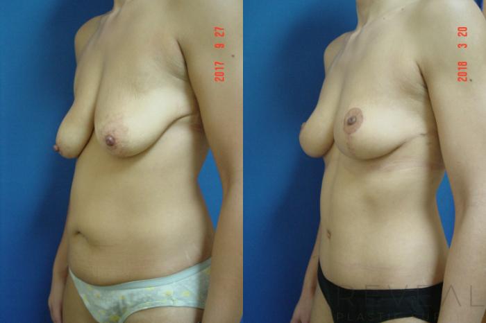 Before & After Tummy Tuck Case 248 View #2 View in San Jose, CA