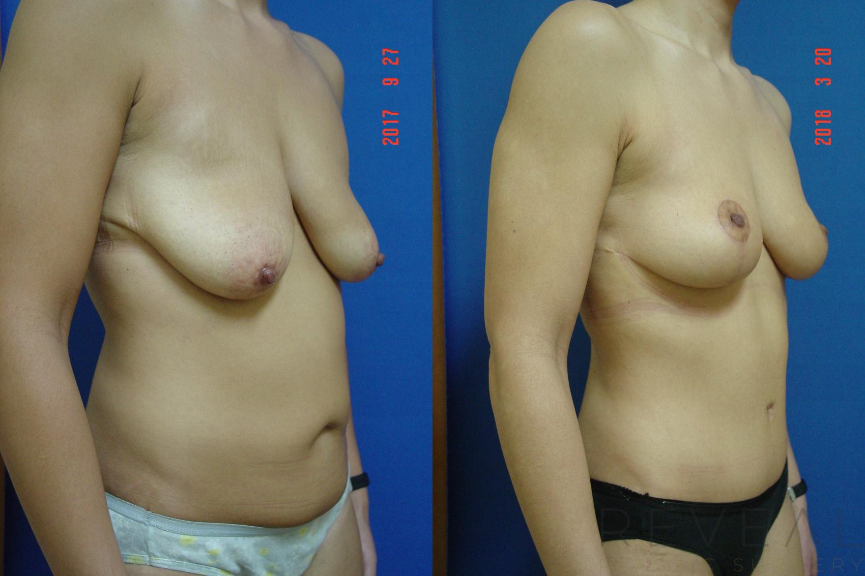Before & After Breast Lift Case 248 View #3 View in San Jose, CA