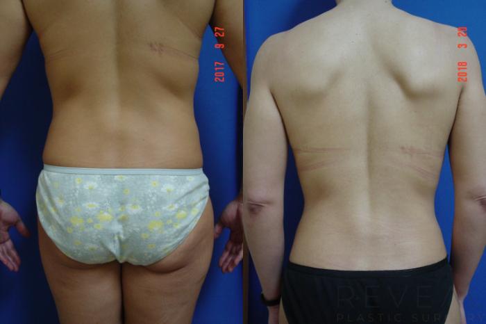 Before & After Tummy Tuck Case 248 View #4 View in San Jose, CA