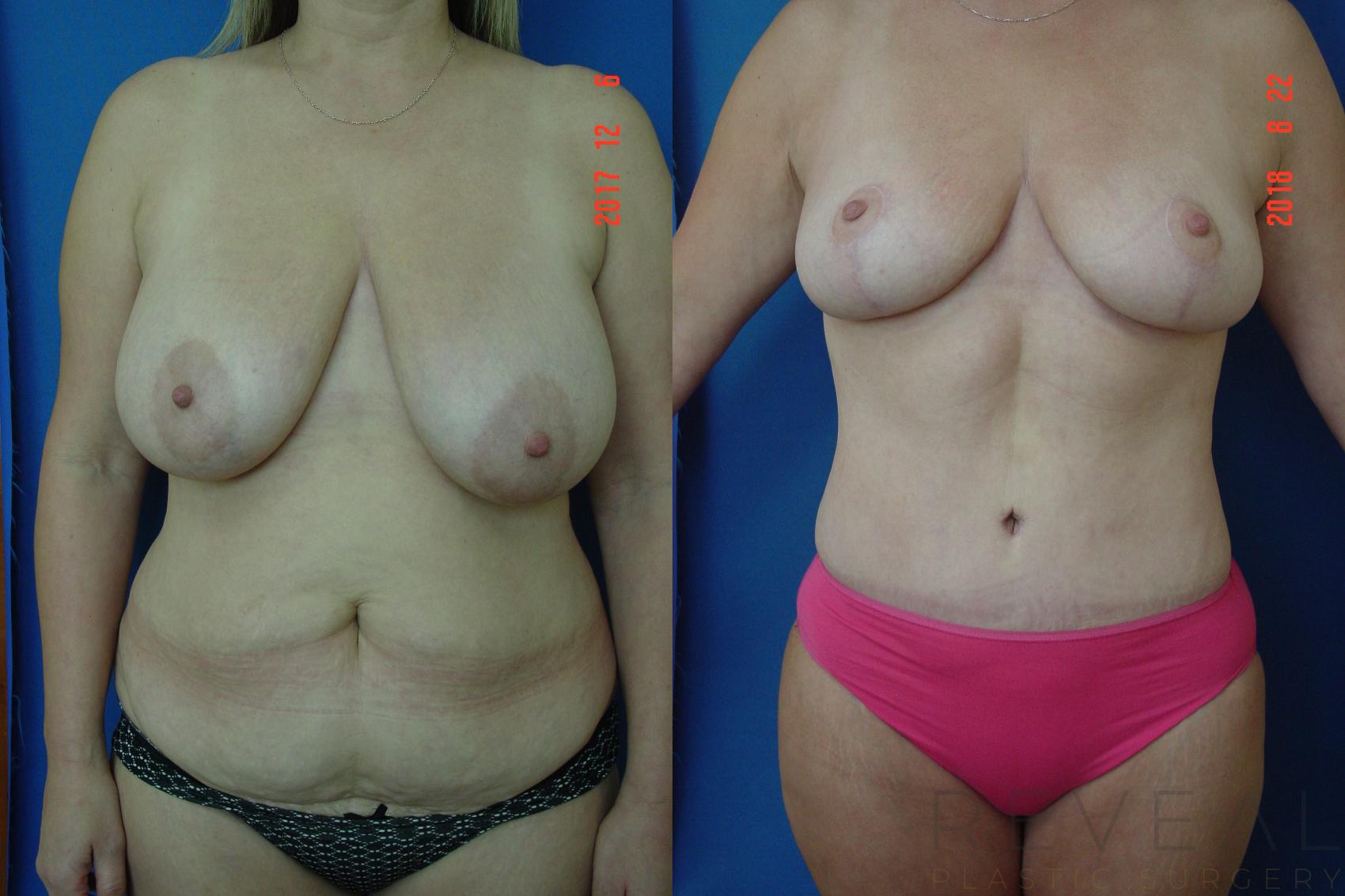 Before & After Breast Reduction Case 261 View #1 View in San Jose, CA