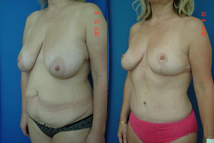 Before & After Tummy Tuck Case 261 View #2 View in San Jose, CA