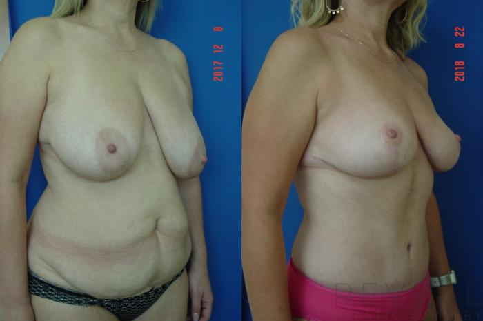 Before & After Breast Reduction Case 261 View #3 View in San Jose, CA