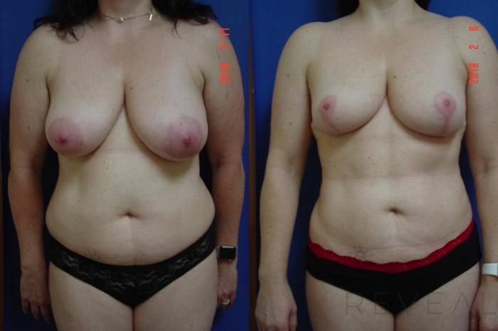 Before & After Breast Reduction Case 299 View #1 View in San Jose, CA