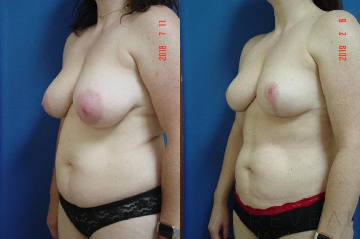 Before & After Breast Reduction Case 299 View #2 View in San Jose, CA
