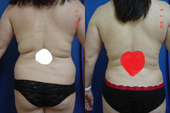 Before & After Breast Reduction Case 299 View #3 View in San Jose, CA