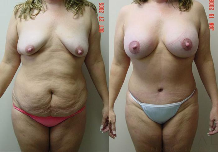 Before & After Liposuction Case 3 View #1 View in San Jose, CA