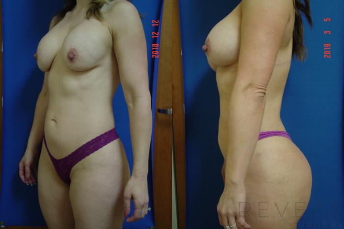 Before & After Breast Augmentation Case 310 View #1 View in San Jose, CA