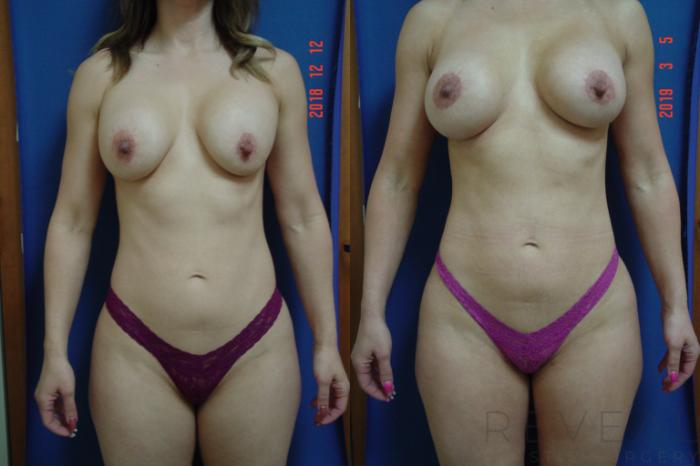Before & After Brazilian Butt Lift Case 310 View #2 View in San Jose, CA