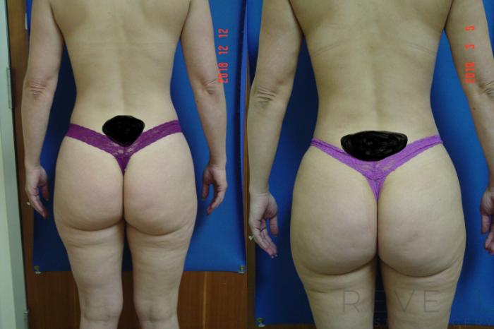 Before & After Brazilian Butt Lift Case 310 View #4 View in San Jose, CA