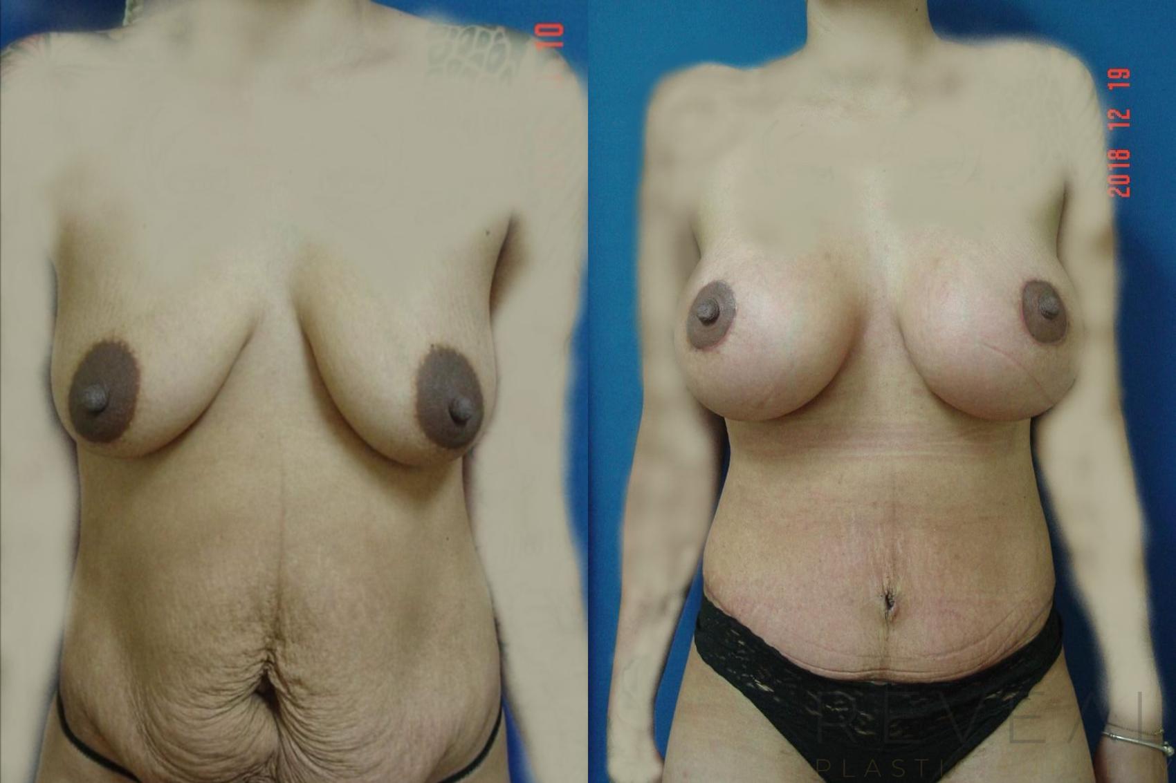 Before & After Breast Augmentation Case 314 View #1 View in San Jose, CA