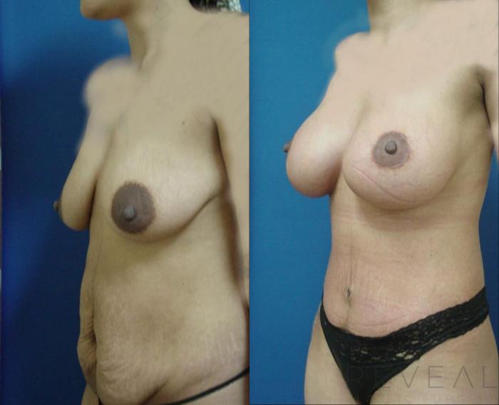 Before & After Liposuction Case 314 View #2 View in San Jose, CA