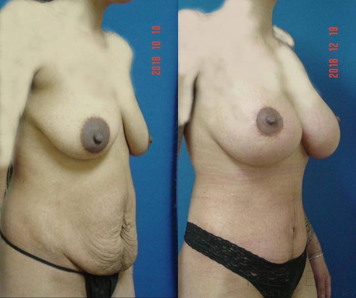 Before & After Breast Augmentation Case 314 View #3 View in San Jose, CA