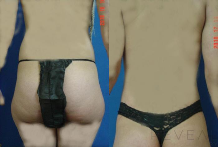 Before & After Breast Augmentation Case 314 View #4 View in San Jose, CA