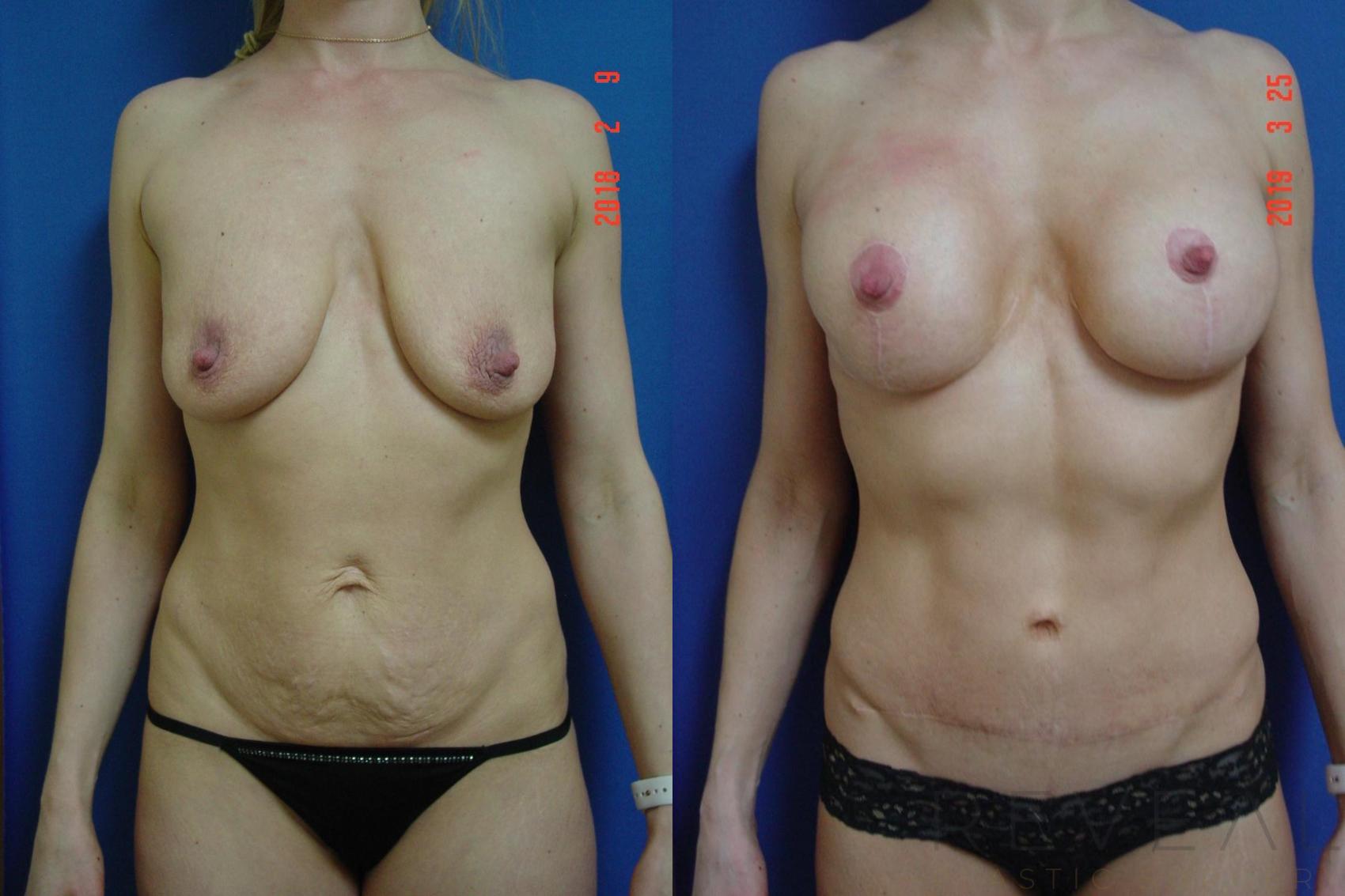 Before & After Breast Augmentation Case 323 View #1 View in San Jose, CA