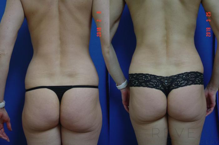 Before & After Tummy Tuck Case 323 View #4 View in San Jose, CA