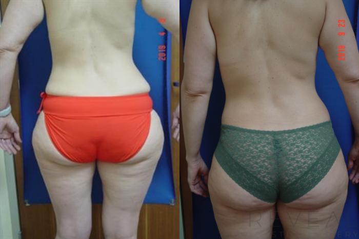 Before & After Liposuction Case 336 View #3 View in San Jose, CA