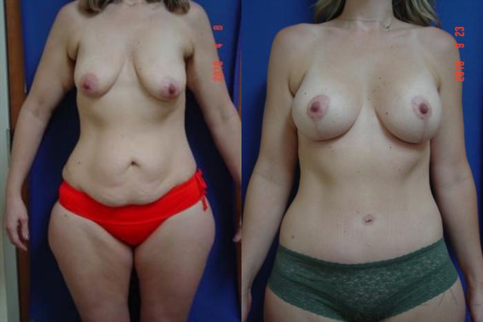 Before & After Liposuction Case 336 View #4 View in San Jose, CA