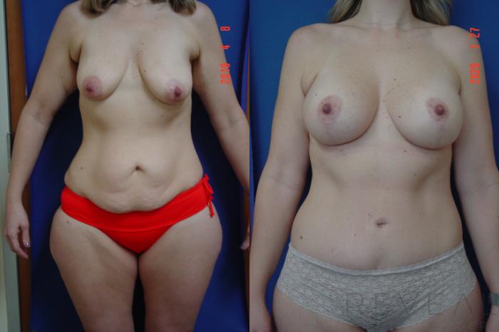 Before & After Breast Augmentation Case 336 View #5 View in San Jose, CA