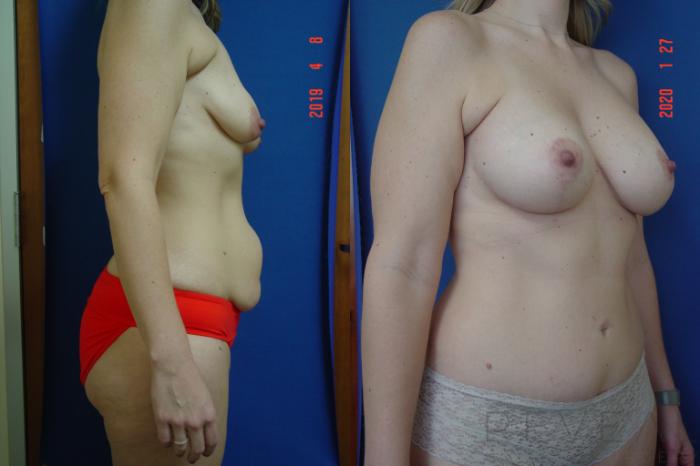 Before & After Breast Augmentation Case 336 View #6 View in San Jose, CA