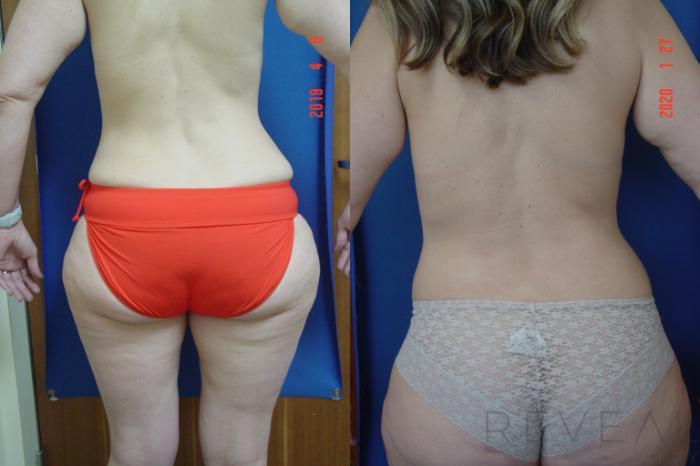 Before & After Liposuction Case 336 View #7 View in San Jose, CA