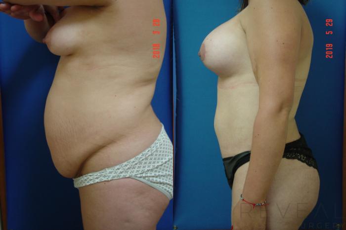 Before & After Liposuction Case 338 View #1 View in San Jose, CA