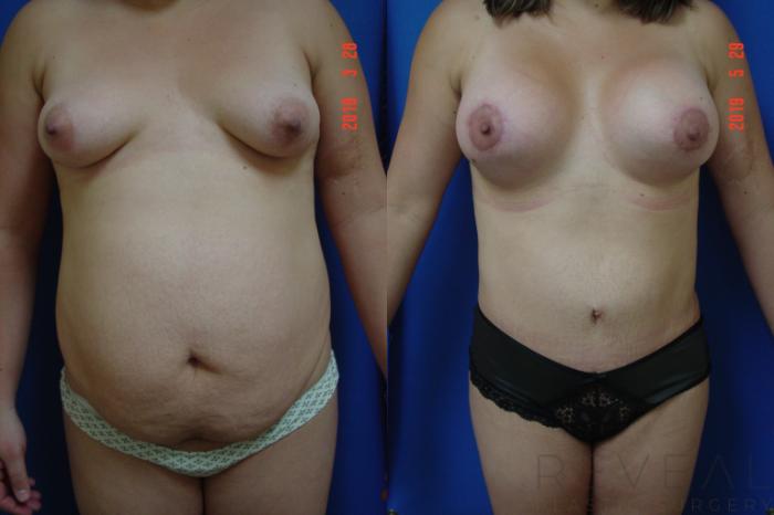 Before & After Brazilian Butt Lift Case 338 View #2 View in San Jose, CA