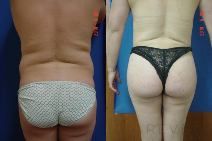 Before & After Liposuction Case 338 View #3 View in San Jose, CA