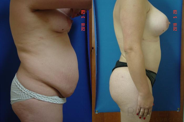 Before & After Liposuction Case 338 View #4 View in San Jose, CA