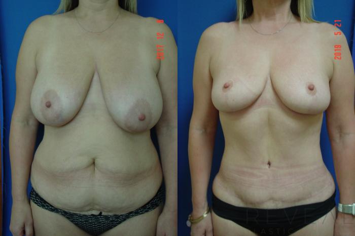 Before & After Breast Reduction Case 341 View #1 View in San Jose, CA