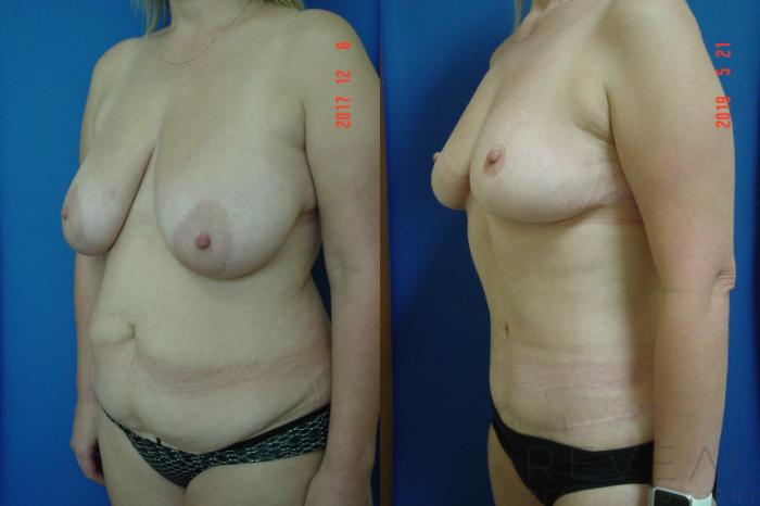 Before & After Breast Reduction Case 341 View #2 View in San Jose, CA