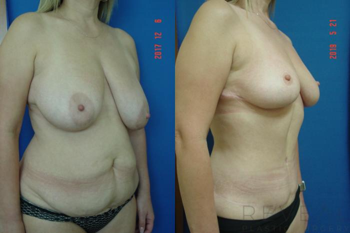 Before & After Breast Reduction Case 341 View #4 View in San Jose, CA