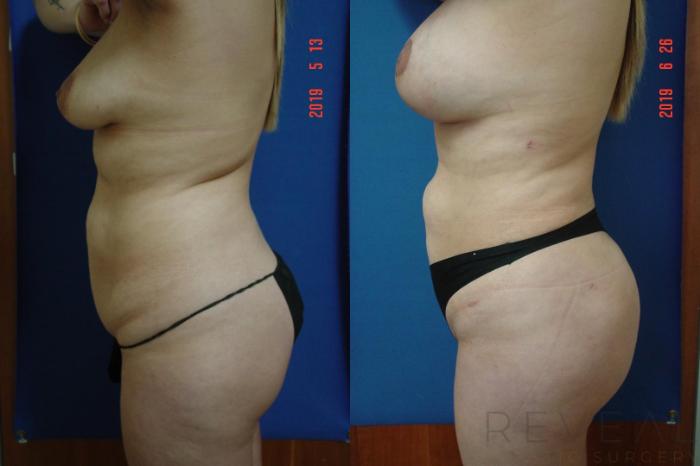 Before & After Brazilian Butt Lift Case 343 View #2 View in San Jose, CA