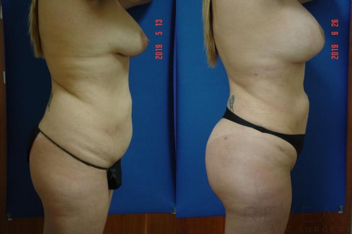 Before & After Brazilian Butt Lift Case 343 View #3 View in San Jose, CA