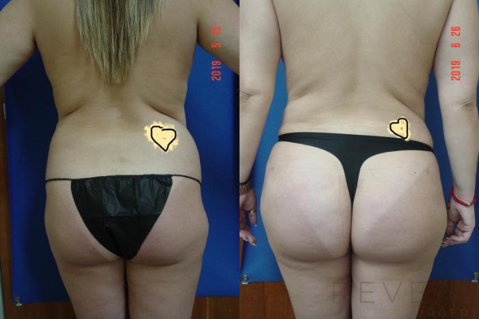 Before & After Brazilian Butt Lift Case 343 View #4 View in San Jose, CA