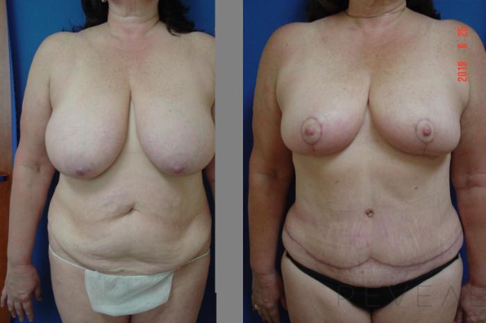 Before & After Breast Reduction Case 344 View #1 View in San Jose, CA