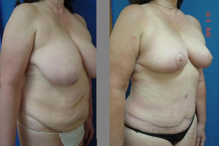 Before & After Tummy Tuck Case 344 View #3 View in San Jose, CA