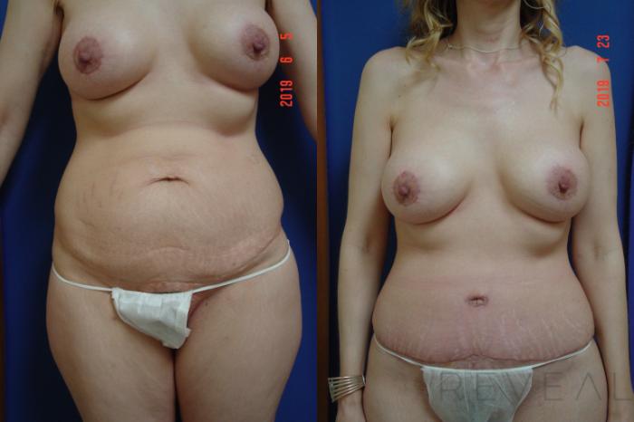 Before & After Tummy Tuck Case 360 View #1 View in San Jose, CA