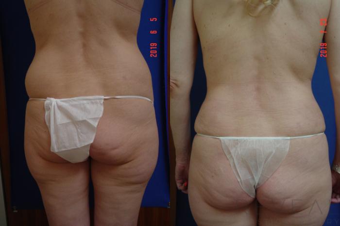 Before & After Tummy Tuck Case 360 View #2 View in San Jose, CA
