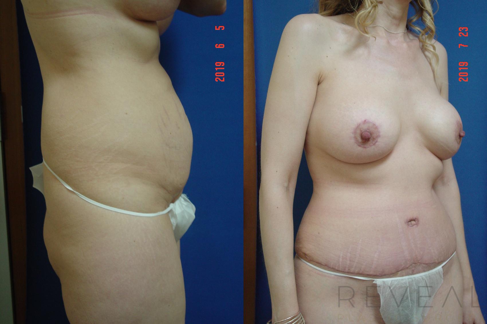 Before & After Breast Lift Case 360 View #4 View in San Jose, CA