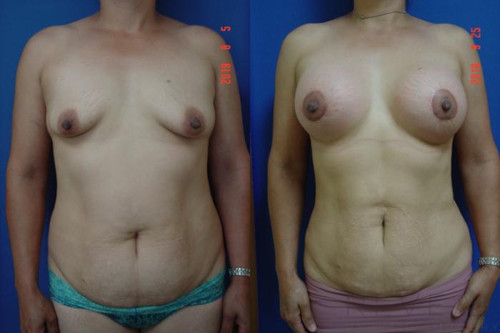 Before & After Breast Lift Case 363 View #1 View in San Jose, CA