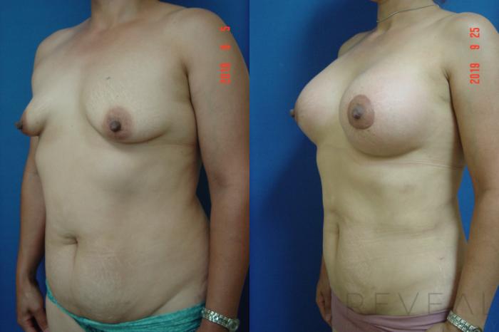 Before & After Breast Lift Case 363 View #2 View in San Jose, CA