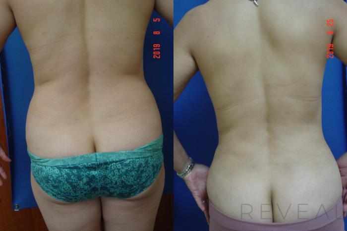 Before & After Liposuction Case 363 View #4 View in San Jose, CA