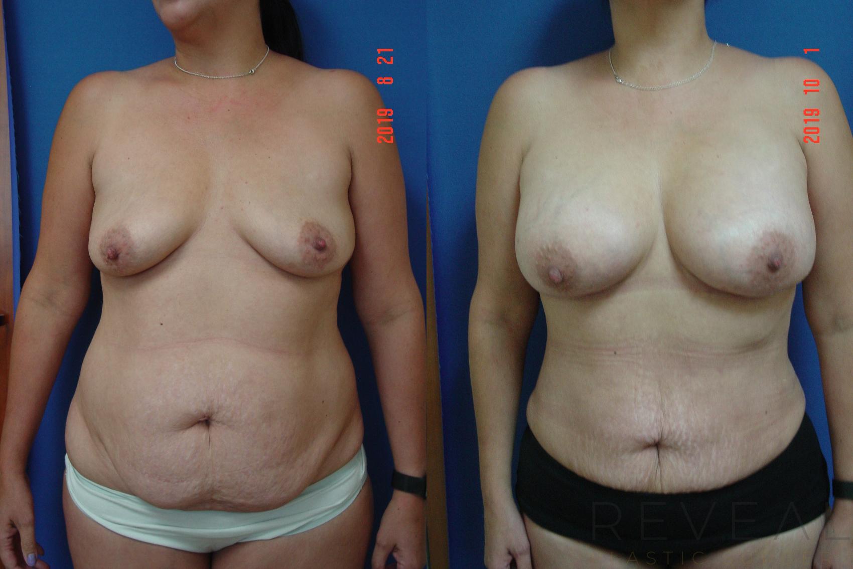 Before & After Fat Transfer to Breasts Case 364 View #1 View in San Jose, CA