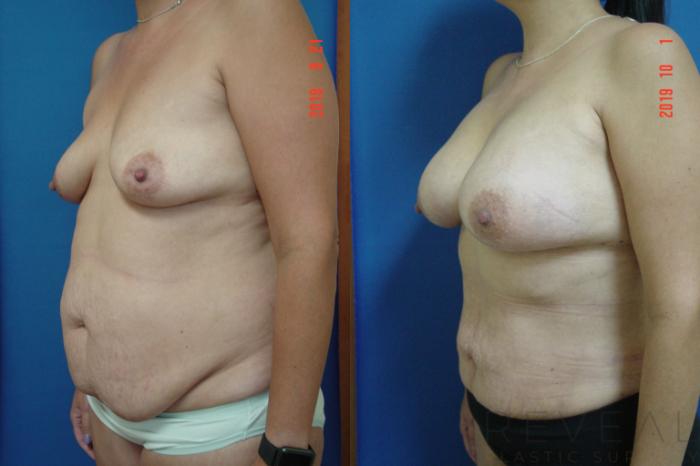 Before & After Breast Augmentation Case 364 View #2 View in San Jose, CA