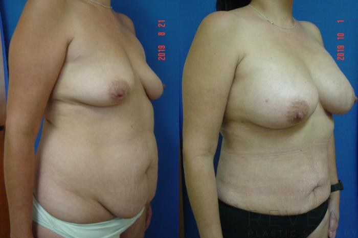 Before & After Liposuction Case 364 View #3 View in San Jose, CA