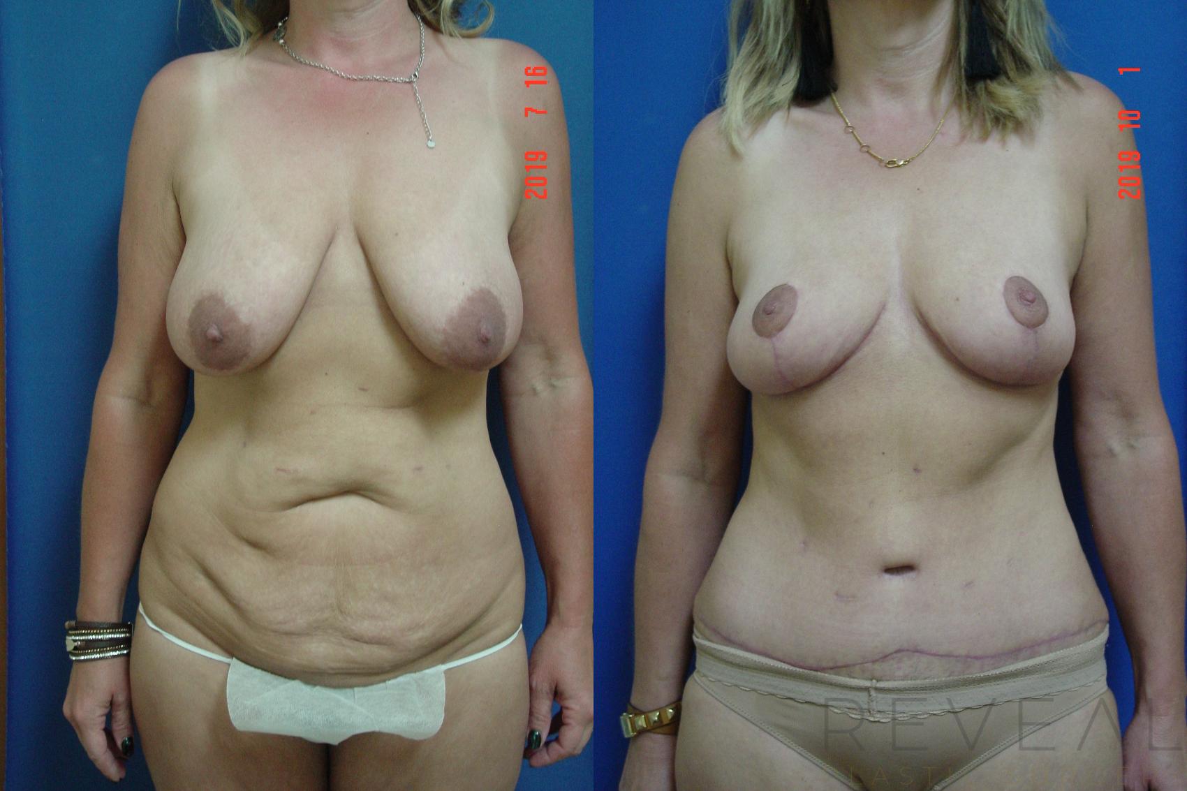 Before & After Tummy Tuck Case 365 View #1 View in San Jose, CA