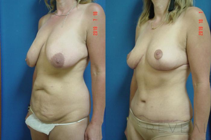 Before & After Tummy Tuck Case 365 View #2 View in San Jose, CA