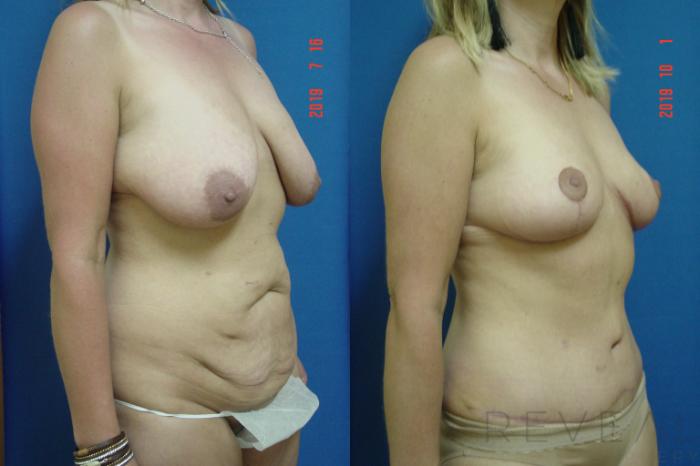 Before & After Breast Augmentation Case 365 View #3 View in San Jose, CA